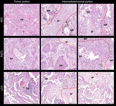 In Situ Overexpression of Matricellular Mechanical Proteins Demands Functional Immune Signature and Mitigates Non-Small Cell <mark class="highlighted">Lung Cancer Progression</mark>
